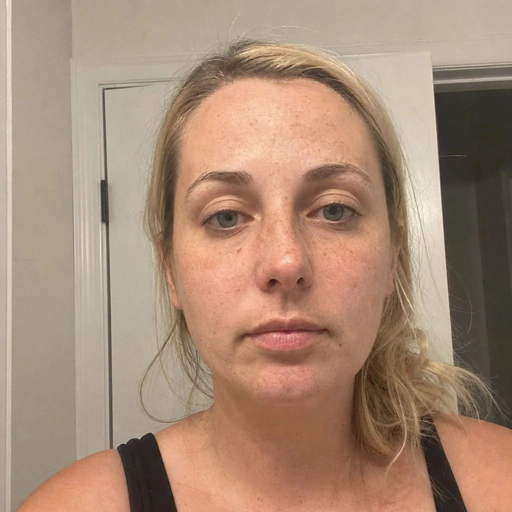 Botox simulation, before