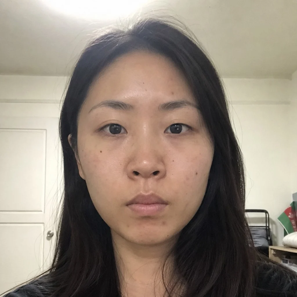 Brow Lift simulation, before