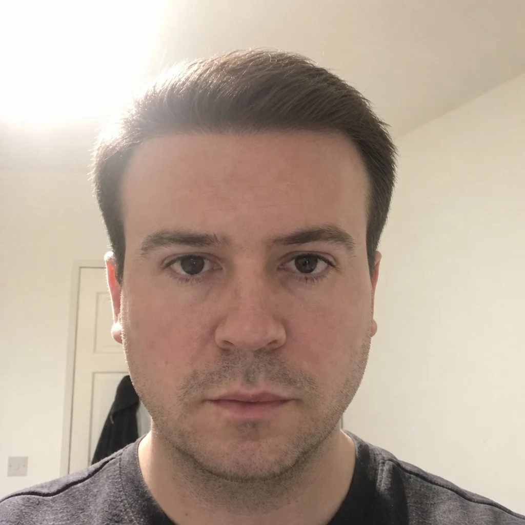The same face with a hair transplant simulation applied by AI