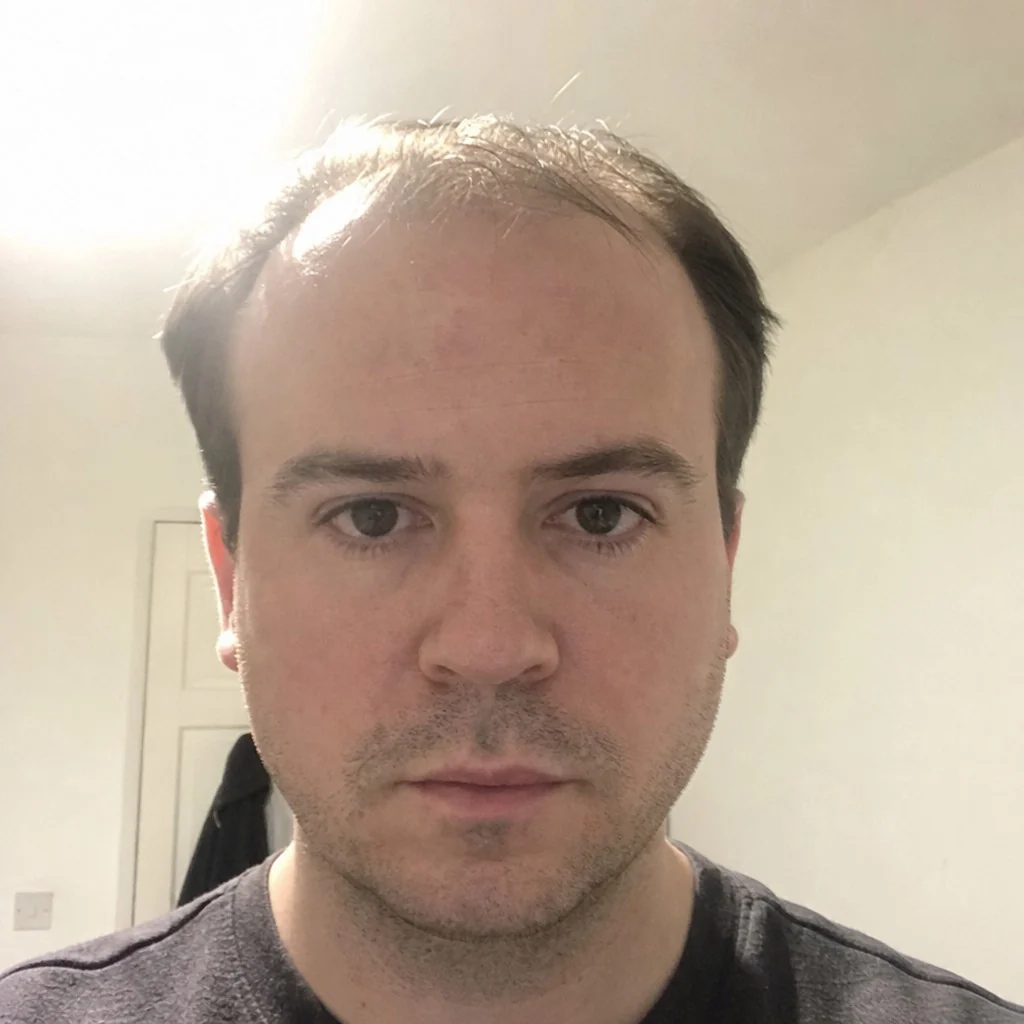 A face before a hair transplant simulation